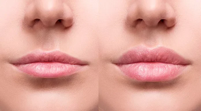 Aumento dos Lábios: Transformando o Sorriso com Procedimentos Estéticos