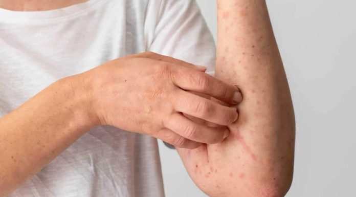 Descamação da pele: Diferenças entre causas alérgicas e dermatológicas