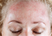 Pele oleosa? Confira aqui como acabar com a oleosidade