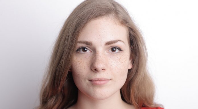 Aceitar as sardas: beleza, identidade e desafios sociais