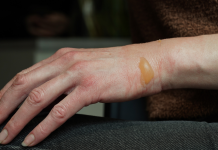 Como tratar a pele após uma queimadura