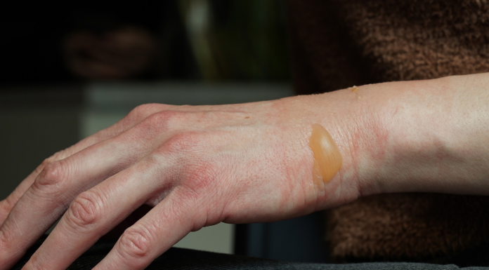 Como tratar a pele após uma queimadura