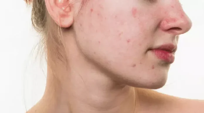 Acne Sob Controle: Tratamentos Naturais que Funcionam