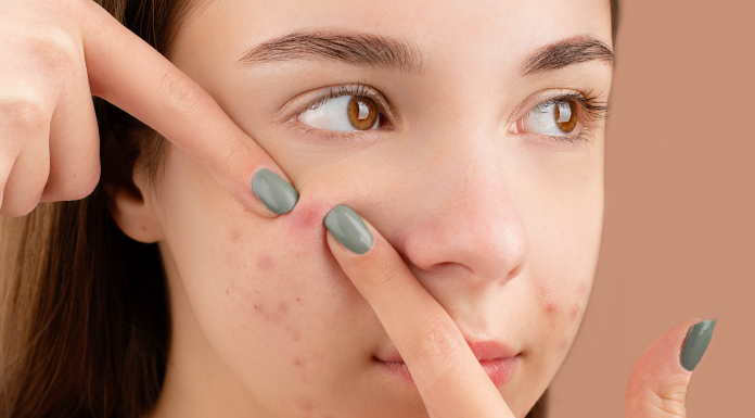Acne nunca mais: dicas de tratamentos naturais para sua pele